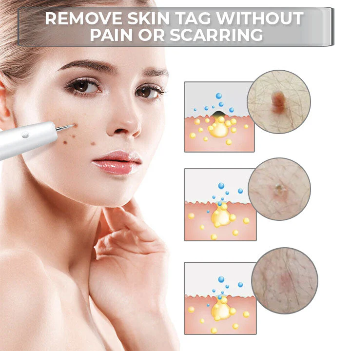 Advanced Plasma Laser Spot Cleaning Pen