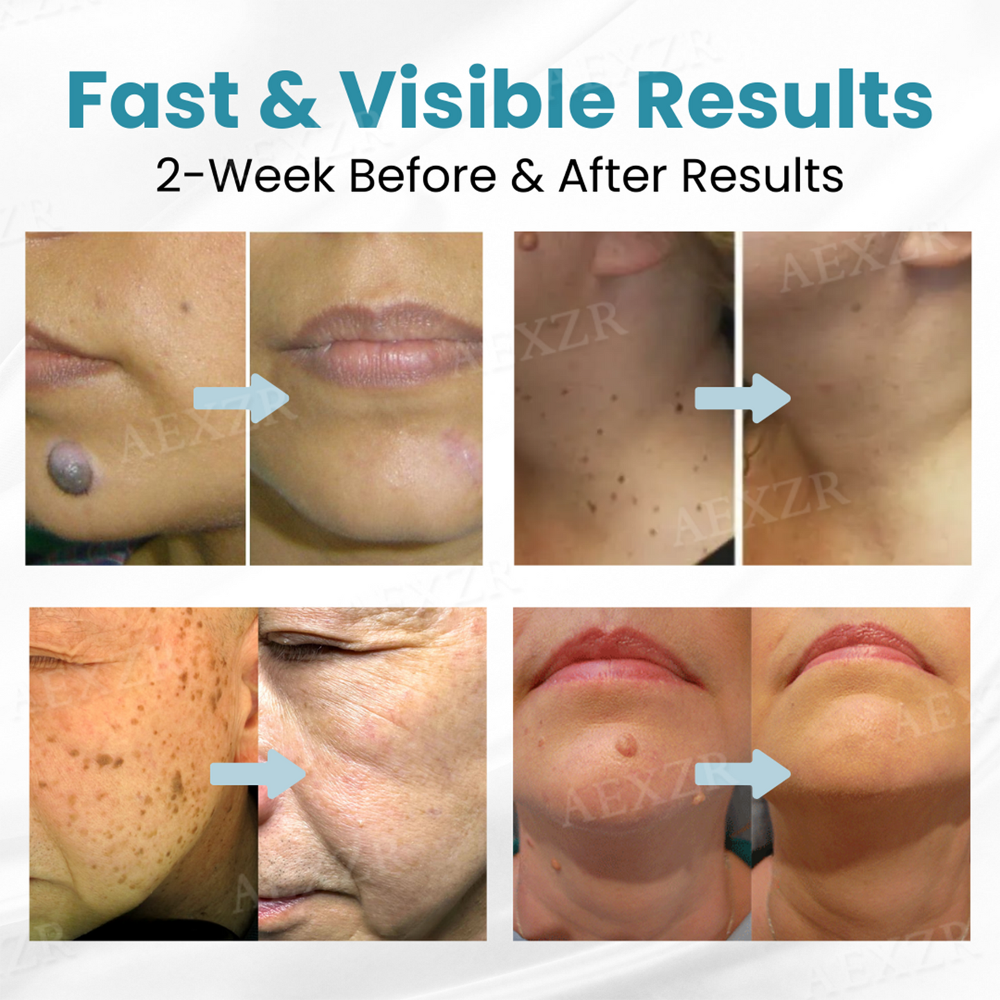 Non-Invasive Mole and Wart Removal Laser Pen PRO
