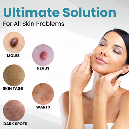 Non-Invasive Mole and Wart Removal Laser Pen PRO