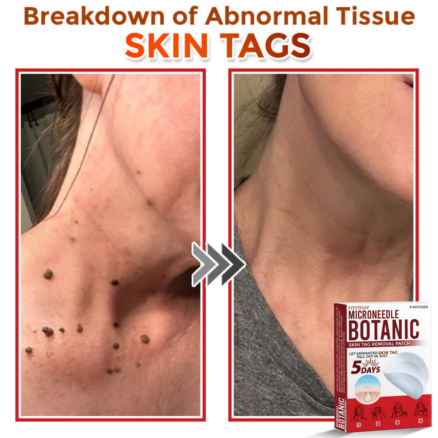 MicroNeedle Botanic Skin Tag Removal Patch 🇺🇸 Made in the USA