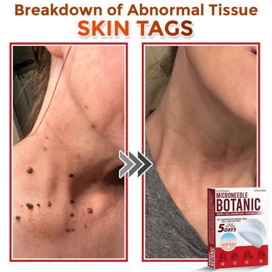 MicroNeedle Botanic Skin Tag Removal Patch 🇺🇸 Made in the USA